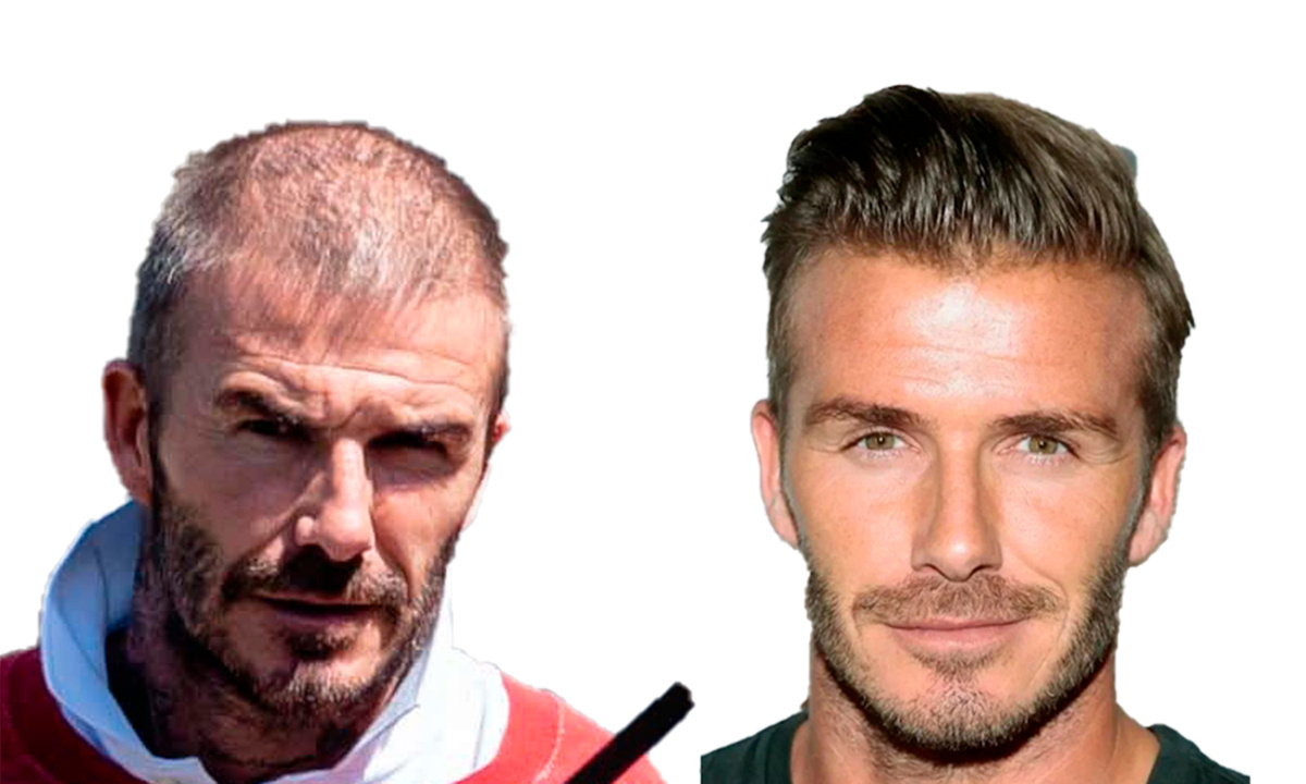 Бэкхэм до и после пересадки