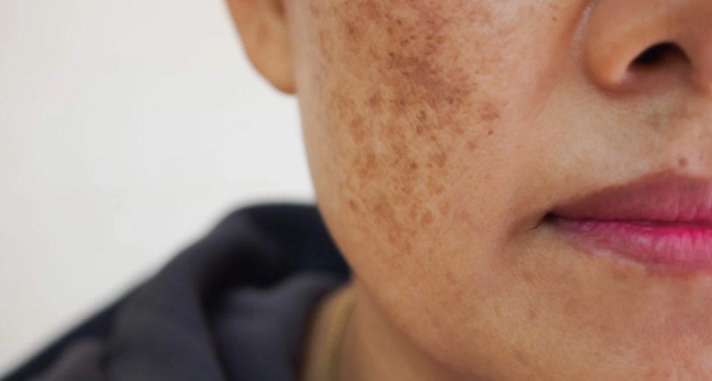 Почему появились пигментные пятна и можно ли их убрать