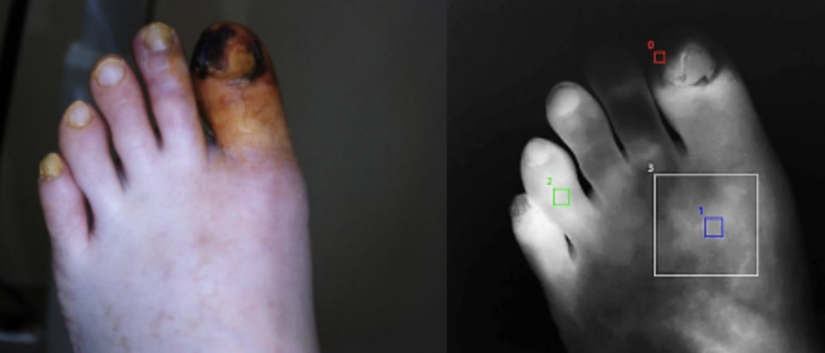 Изображение с экрана монитора системы «МАРС», флуоресценция с красителем Индоцианин зеленый.