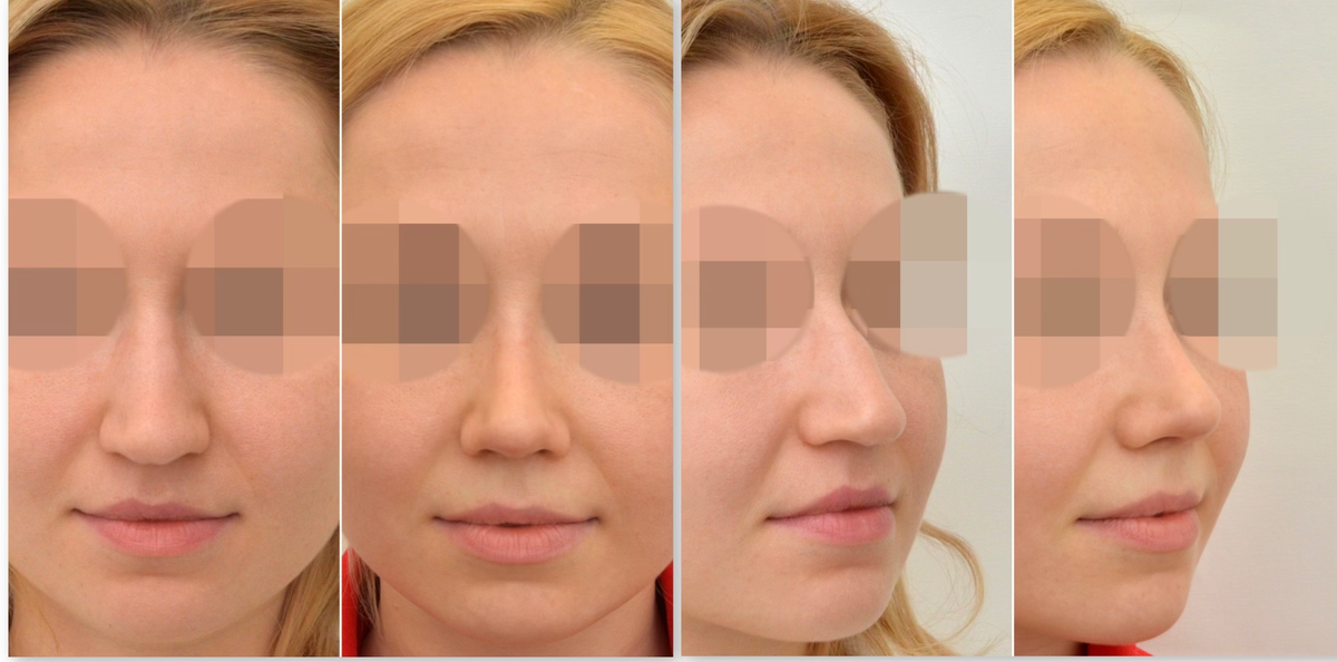 Ринопластика до и после операции, пластический хирург Стайсупов В.Ю.