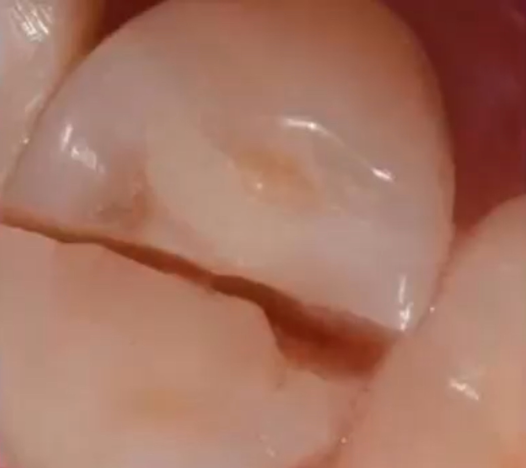 Трещина коронковой части зуба и корня, на глубину 5мм под десну. 