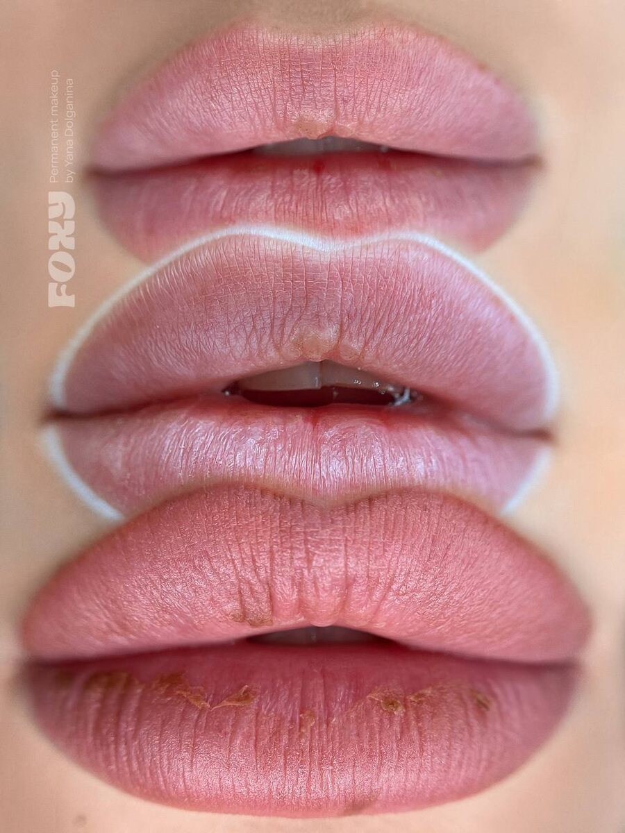 До/эскиз/губы на 3-й день.
Многие боятся, что заживать будет некрасиво и нужно прятаться дома) вот наглядный пример какие «корочки» у вас будут 😁