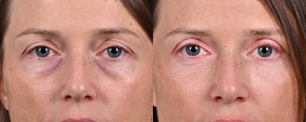 Блефаропластика и липофилинг век фото до и после. Фото с сайта хирурга Д.Р. Гришкяна. Имеются противопоказания, требуется консультация специалиста