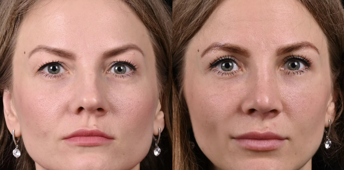 Устранили излишки кожи на верхнем веке и по желанию пациентки выполнили липофилинг носослезной борозды. Фото до и после. Фото с сайта хирурга Д.Р. Гришкяна. Имеются противопоказания, требуется консультация специалиста