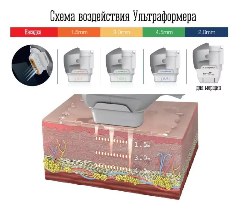 смас лифтинг ультраформер