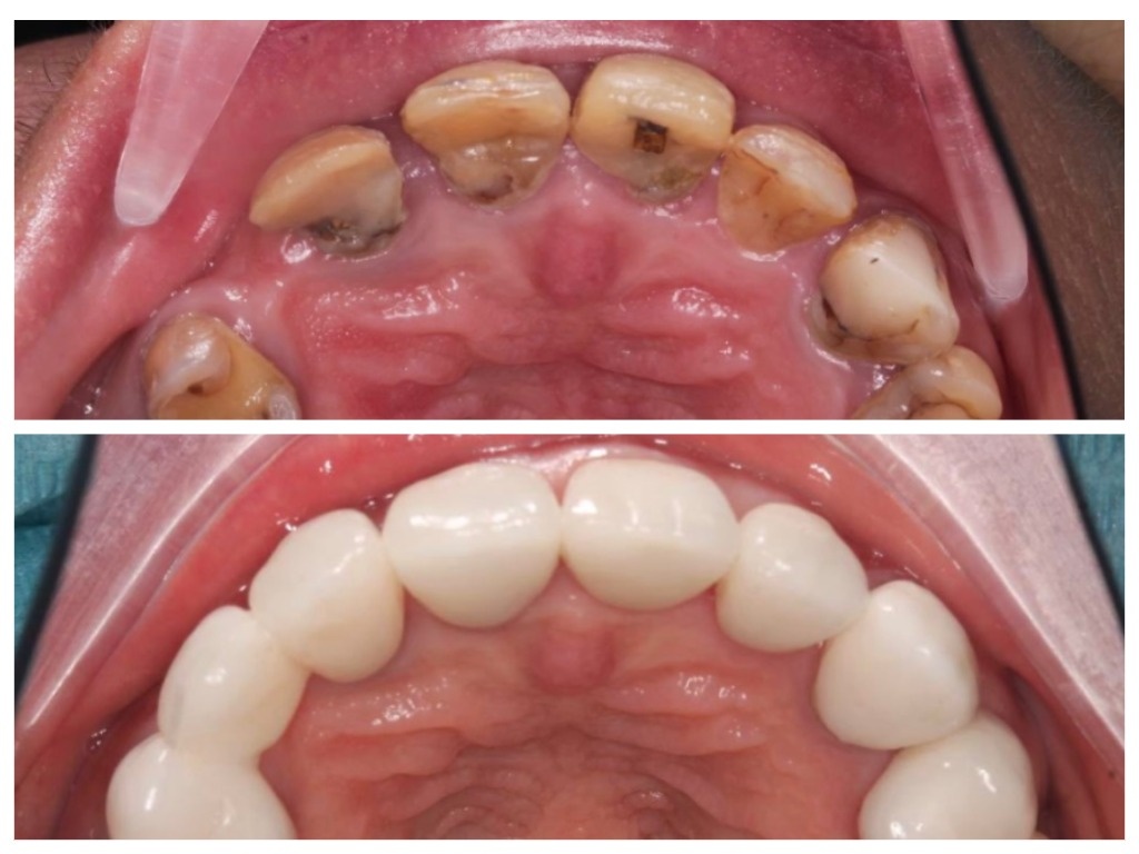 Представляем результат нашего стоматологического лечения: до и после установки моста. Теперь наш пациент может наслаждаться красивой и здоровой улыбкой