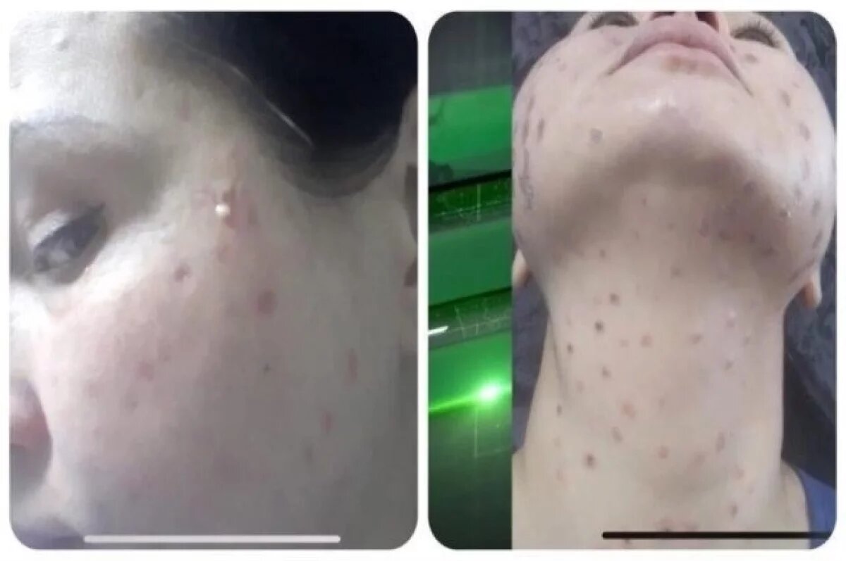    Жительница Уфы чуть не умерла после похода к косметологу