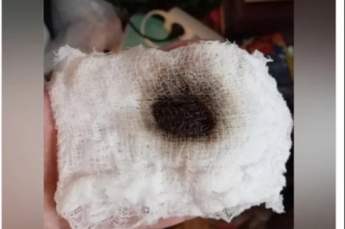    Жители Озерска жалуются на высыпания на теле из-за воды с «мазутом»