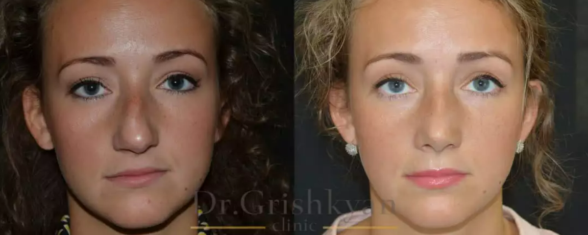 Устранение искривления спинки носа, и прежде всего носовой перегородки. Фото до и после. Фото с сайта хирурга Д.Р. Гришкяна. Имеются противопоказания, требуется консультация специалиста