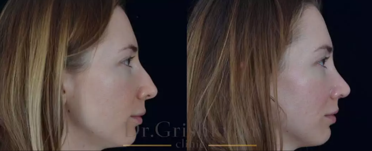 Риносептопластика фото до и после. Фото с сайта хирурга Д.Р. Гришкяна. Имеются противопоказания, требуется консультация специалиста