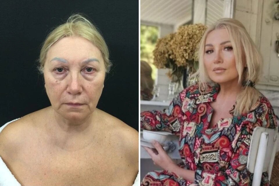 Марина Логинова до и после операции. Фото: Юлия Махновец/Алена Пятенок 