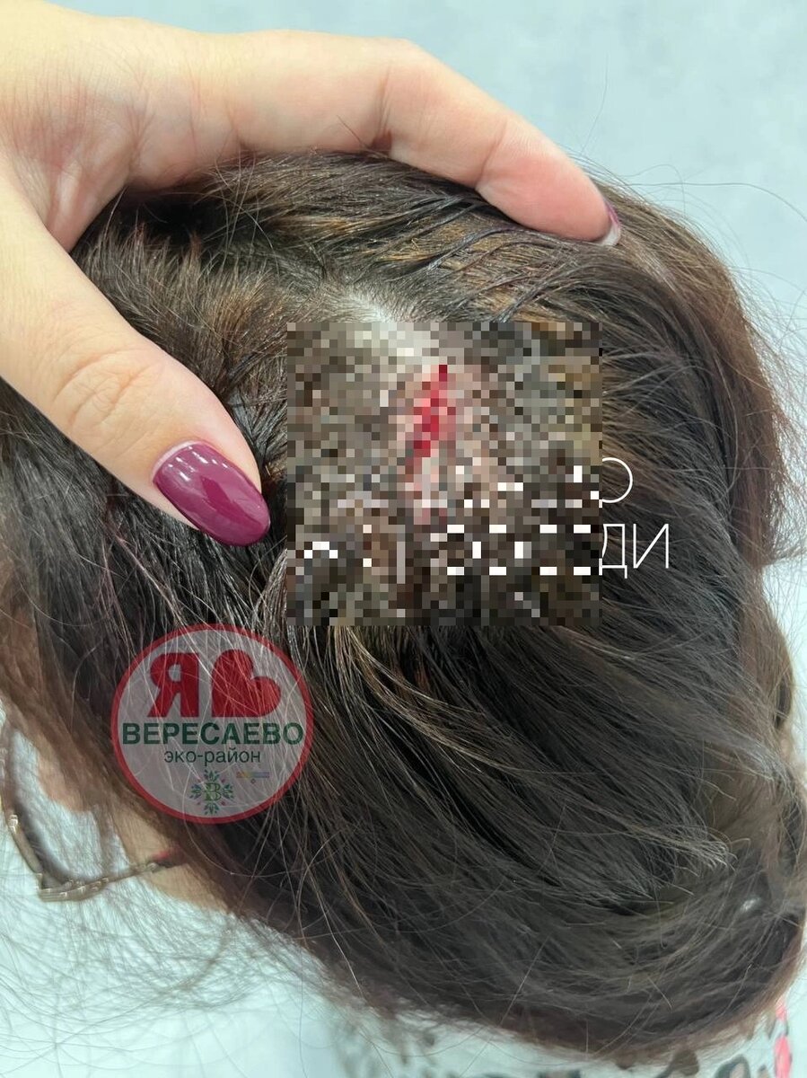    Рассечённая голова девочки. Фото: Telegram/ ЖК «Вересаево»