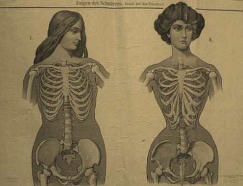 Рисунок 19 века, доказывающий вред, наносимый корсетом. Подобная деформация была не у каждой девушки, но тем не менее)