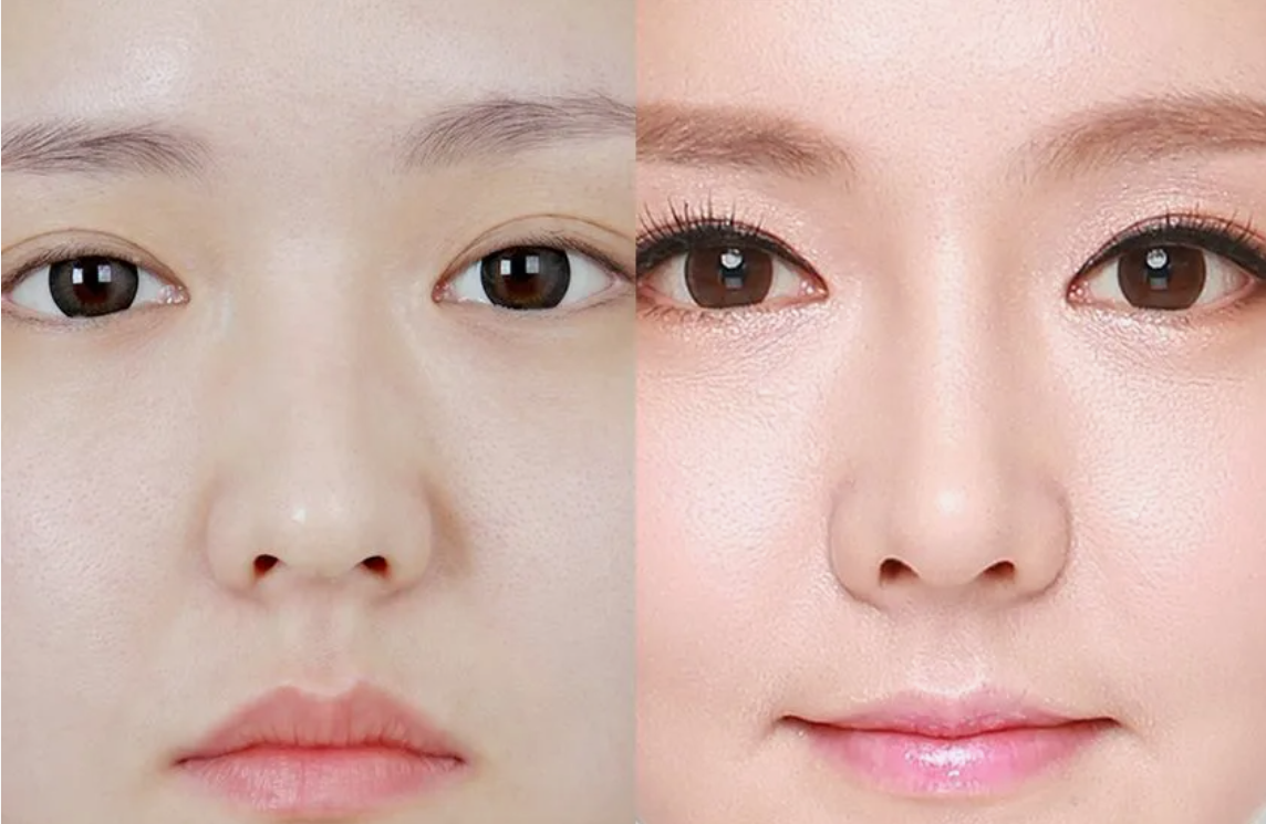 Результат, достигнутый риноплатикой - типичный "азиатский" нос с плоской переносицей превращен в европейский - с более выраженной спинкой и переносицей. Для такого эффекта больше не обязательно ложиться под нож хирурга, достаточно инъекции гиалуронки раз в несколько месяцев. 