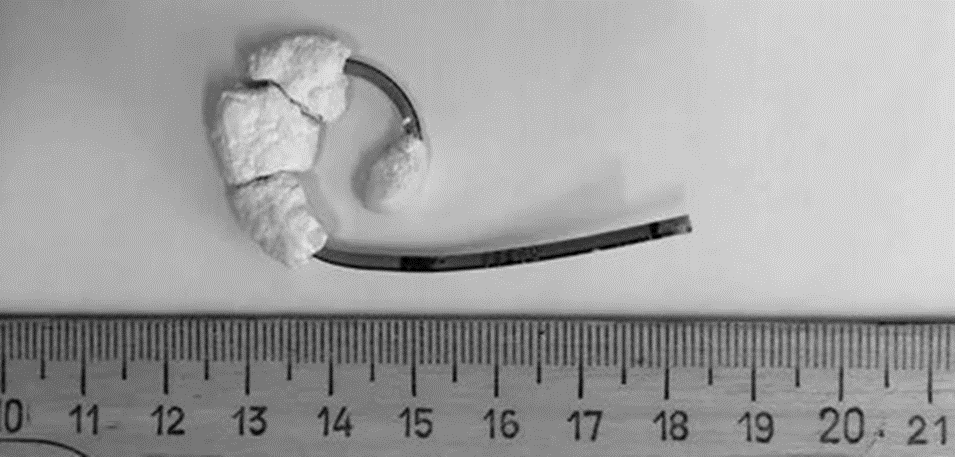 На снимке – камнеобразование на забытом стенте