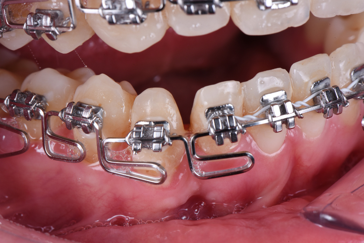 Зубы 4.2 и 4.3 у пациентки неправильной формы 