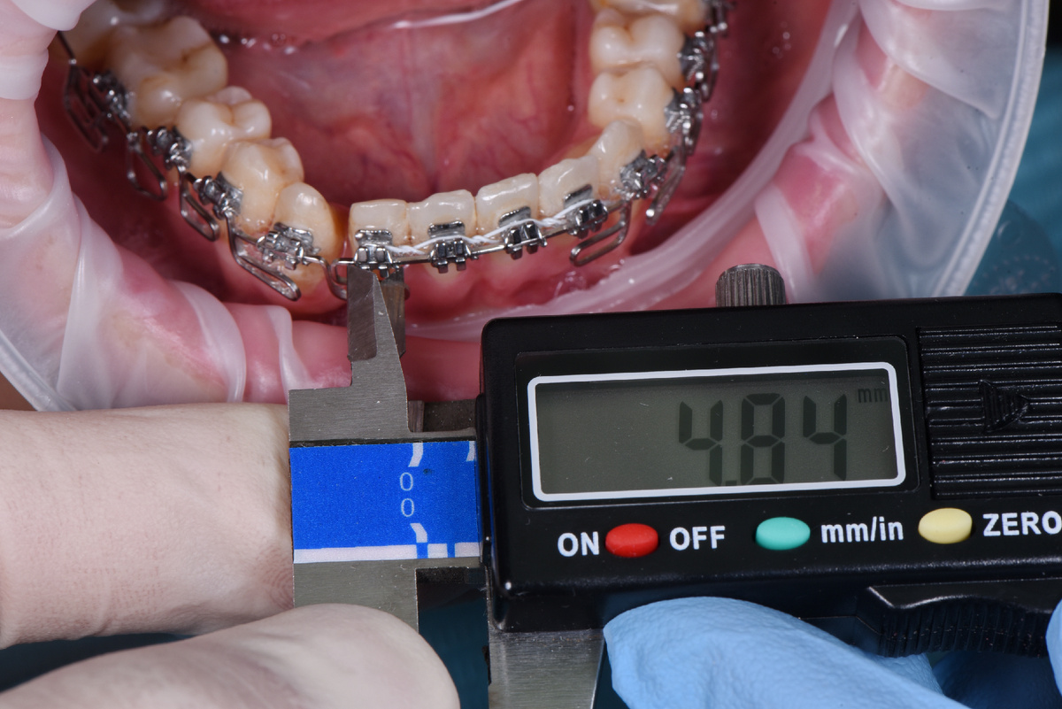 Измерили коронки зубов и расстояние между двумя зубами