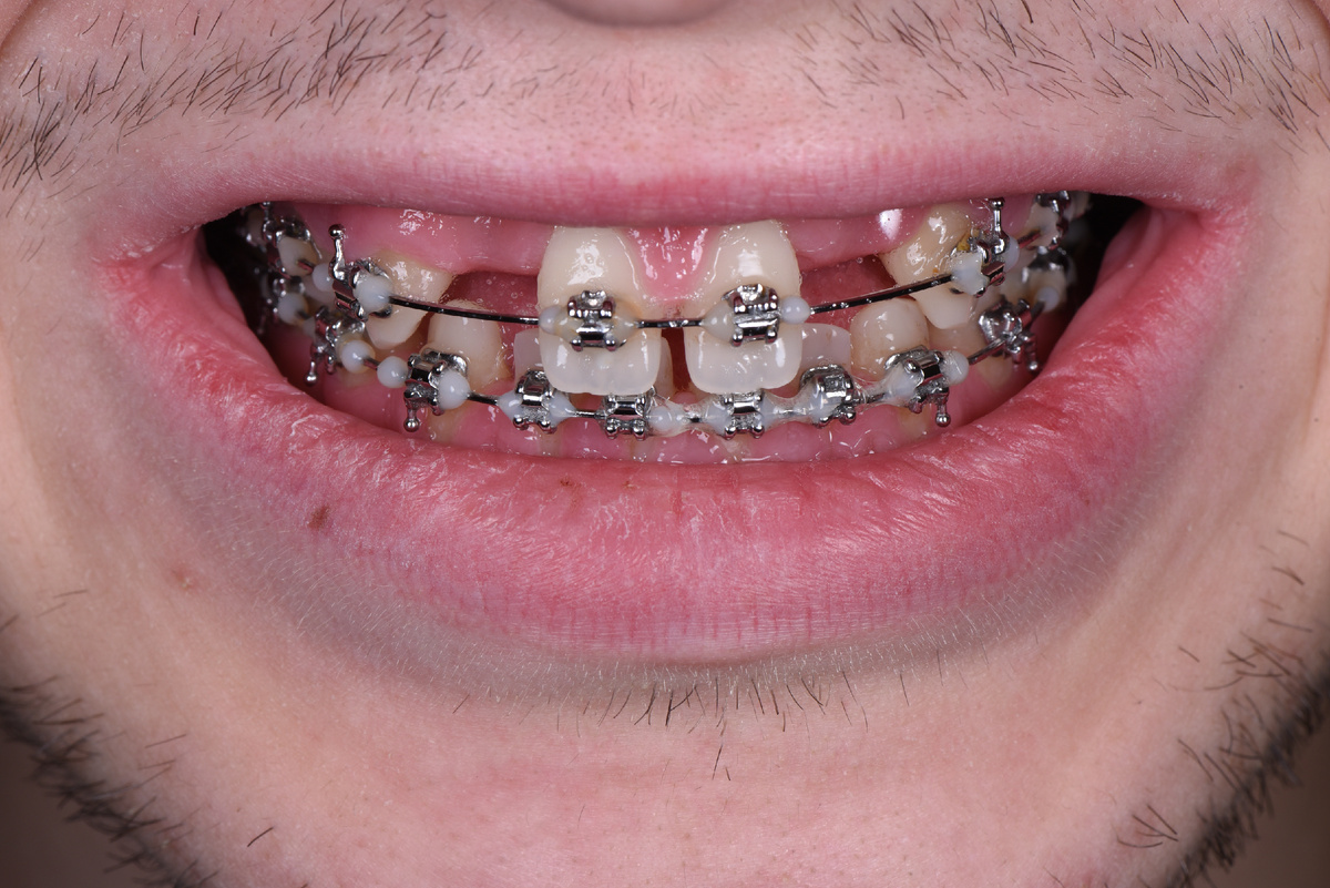 У Максима отсутствуют верхние резцы, а имеющиеся зубы не соответствуют росту