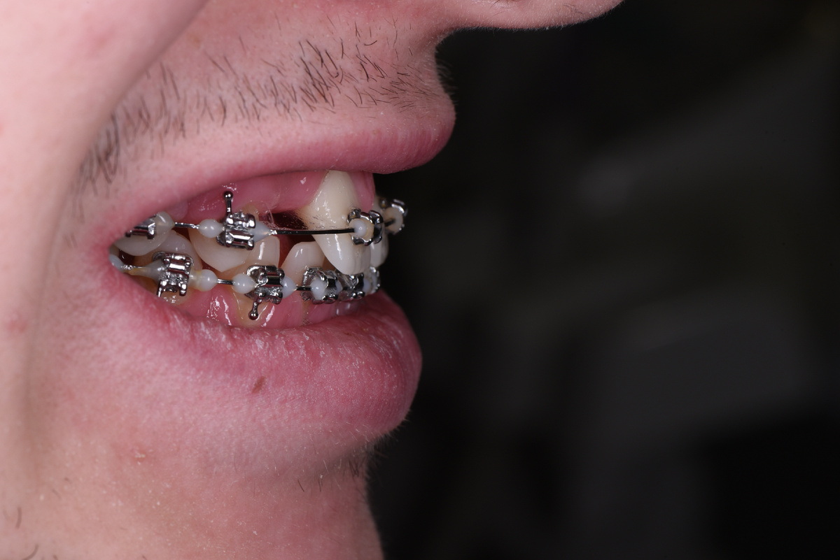 На момент обращения пациент носил брекет-систему уже полтора года 