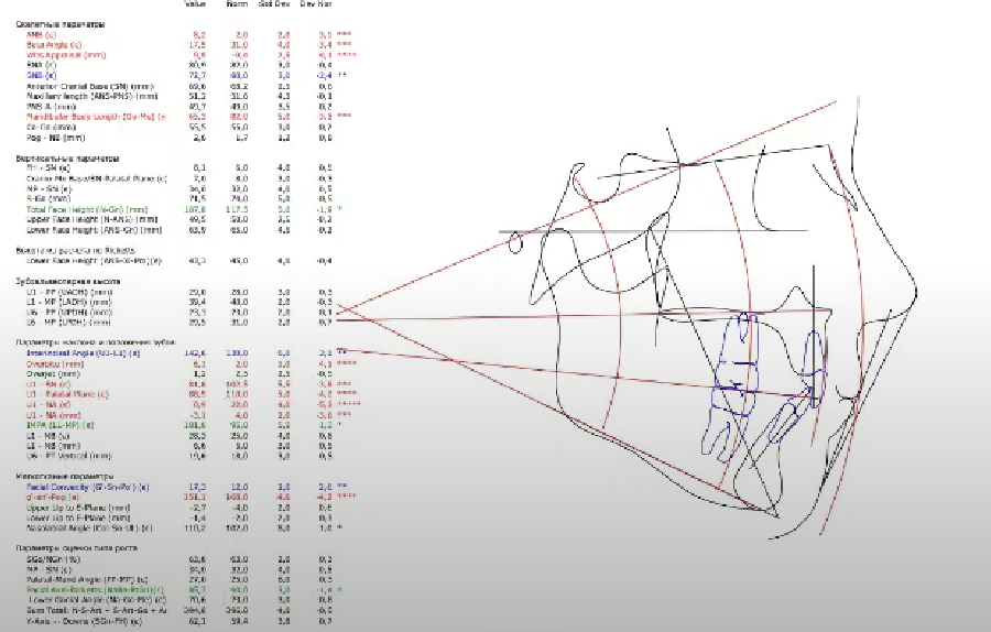 3D-цефалометрия: угол наклона верхних резцов на 25 градусов меньше нормы