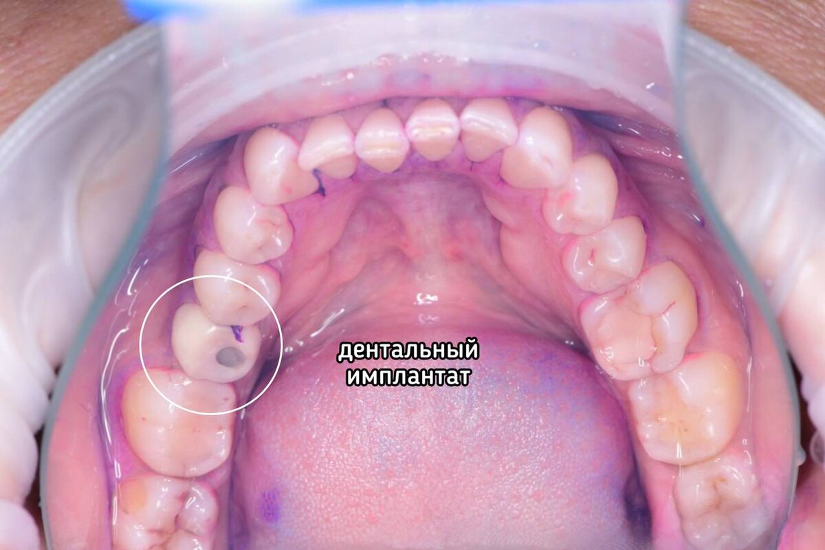 С имплантатом пациентки все в порядке