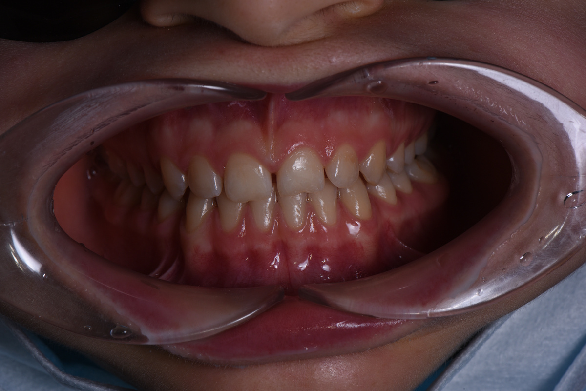 Зубы пациентки без брекет-системы, поставленной в сторонней клинике