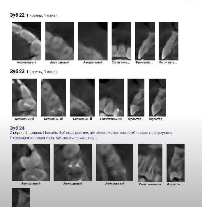 Подробный разбор каждого зуба в программе Диагнокат 