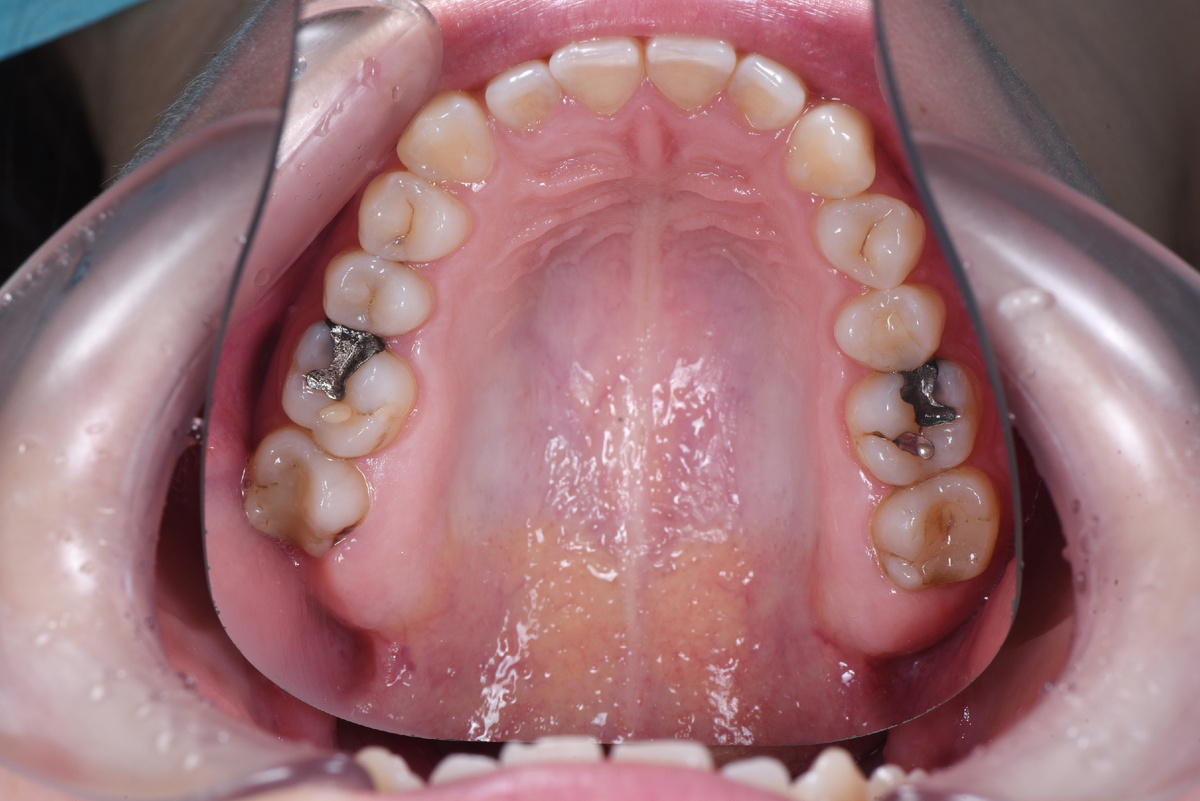 Амальгамовые пломбы на зубах 1.6 и 2.6 