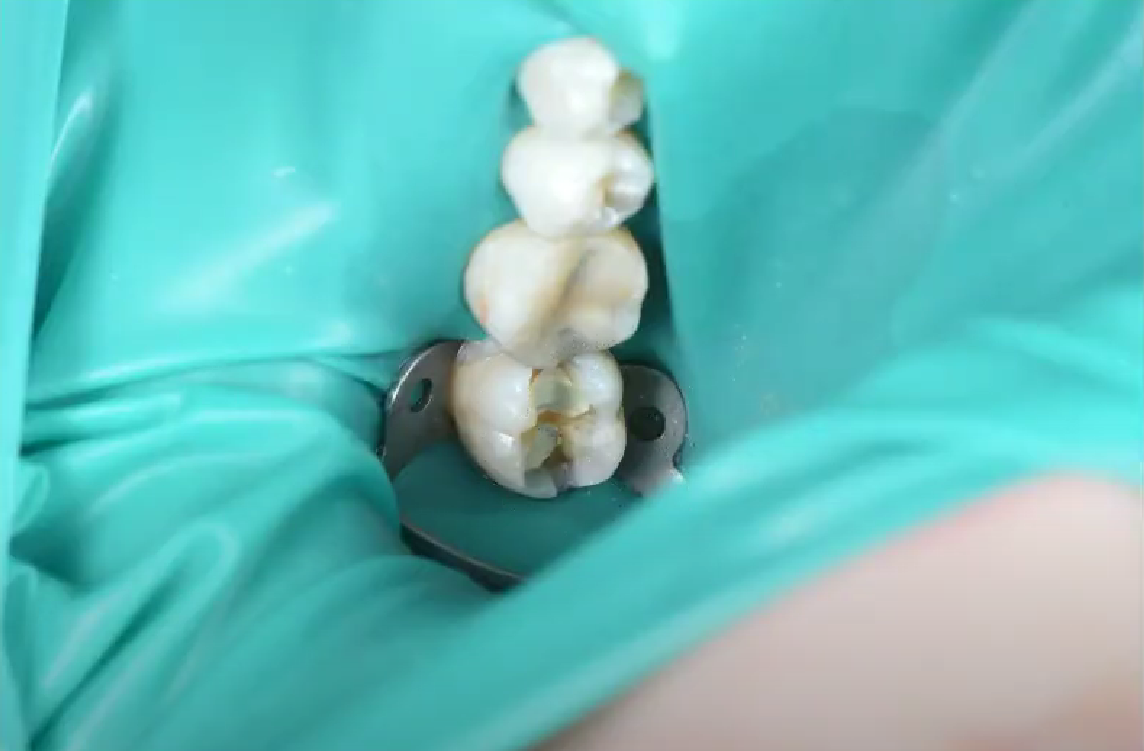 Изоляция зубов с помощью коффердама 