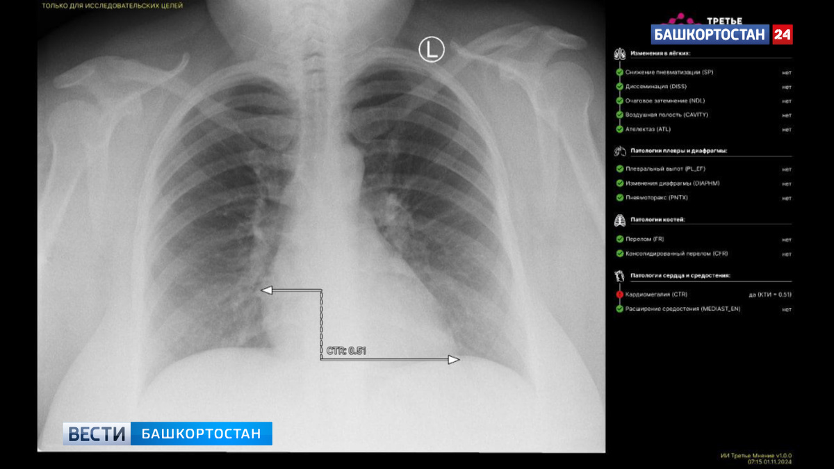   В Башкирии искусственный интеллект впервые расшифровал рентгеновский снимок пациента