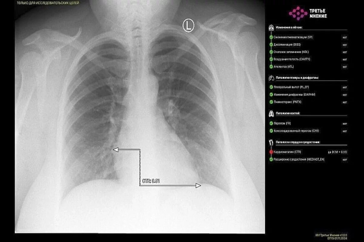    В Башкирии впервые искусственный интеллект расшифровал рентгеновский снимок