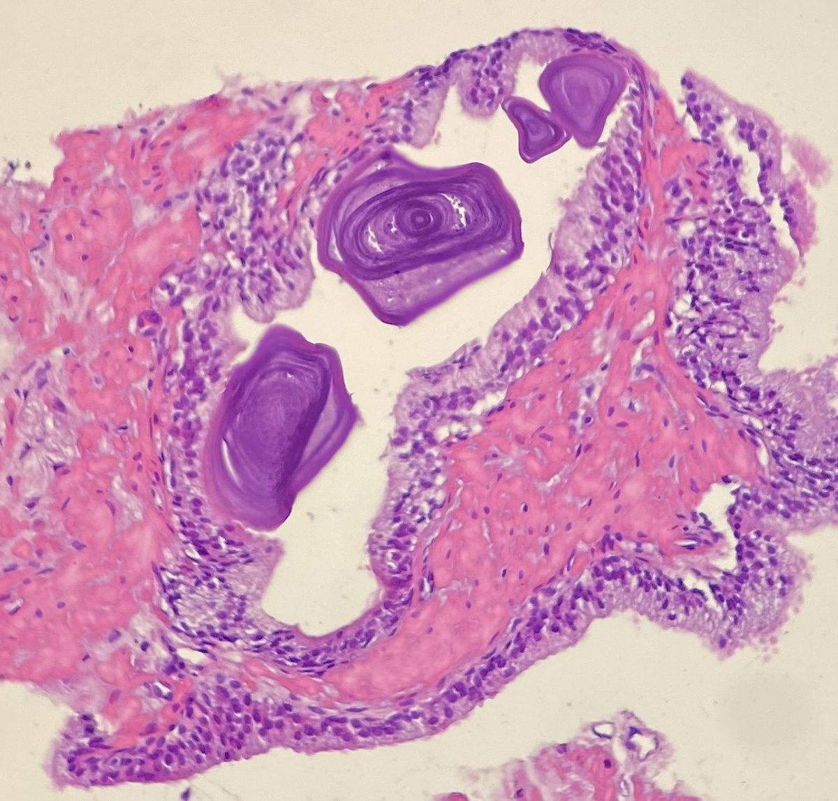 Фрагмент простаты с амилоидными тельцами (как цветочки).