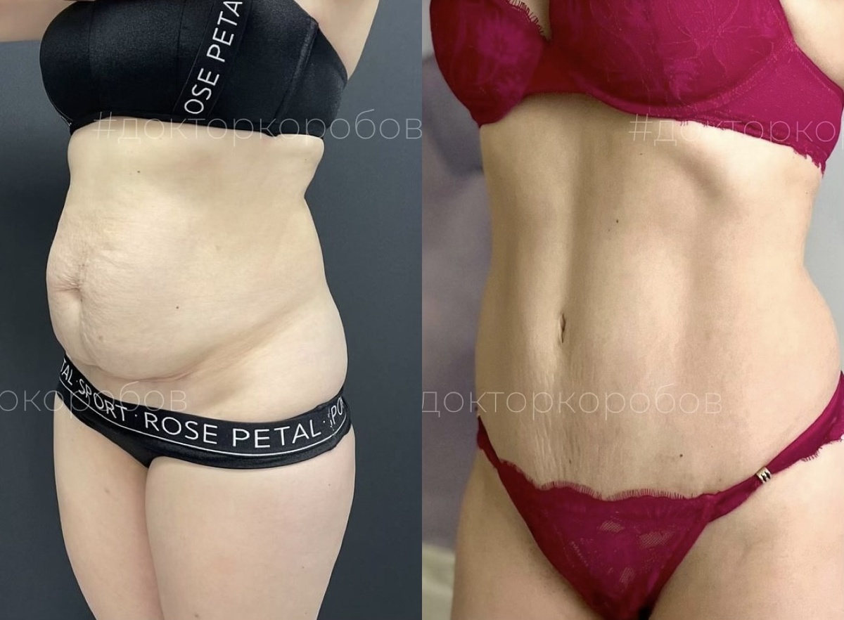 Липосакция живота + абдоминопластика с ушиванием диастаза. Результат через год после операции.