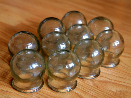 Фото : https://upload.wikimedia.org/wikipedia/commons/1/1f/Медицинские_банки.jpg