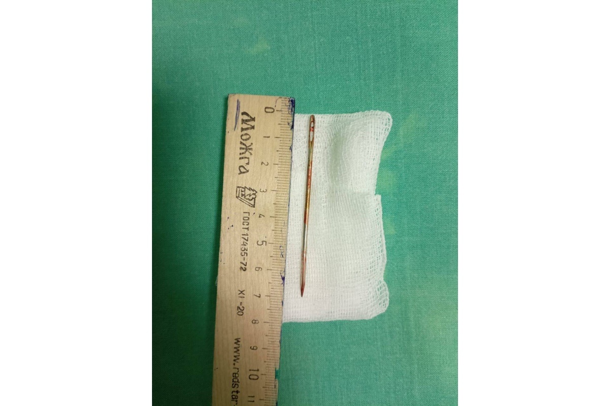 Пресс-служба минздрава Московской области📷В ходе обследования врачи выявили в уретре иглу длиной 7 см