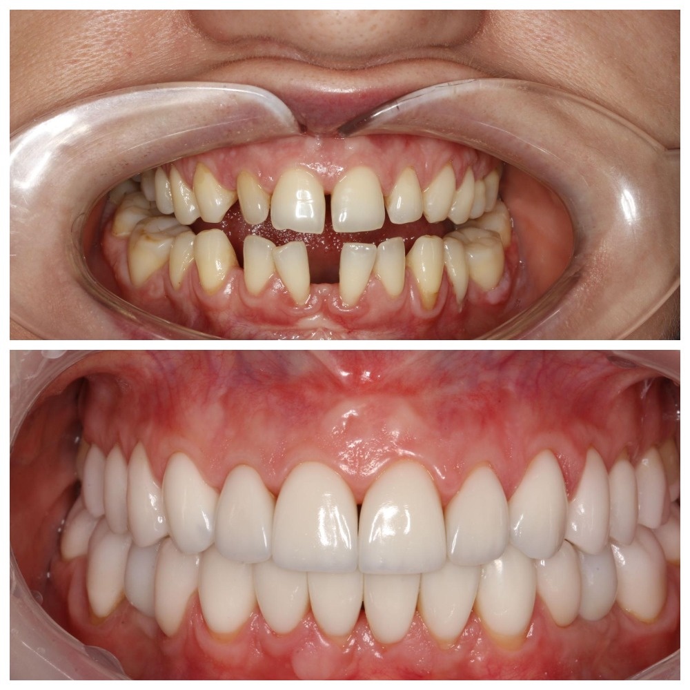 Фото зубов до реставрации и ортодонтического лечения: требовалась коррекция брекетами из-за отсутствия премоляров (Источник: фото эксперта)