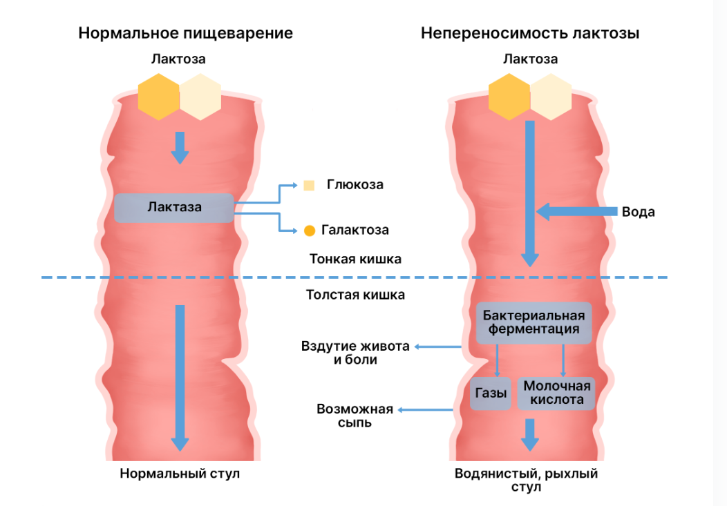 Патогенез ЛН в сравнении с нормальным пищеварением. Скриншот со статьи Леонтьевой Г.А. "Непереносимость лактозы"
