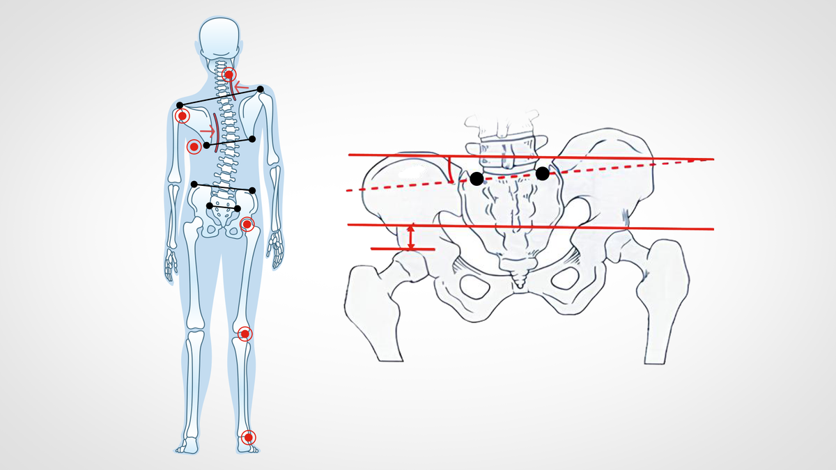 сколиоз и асимметрия таза