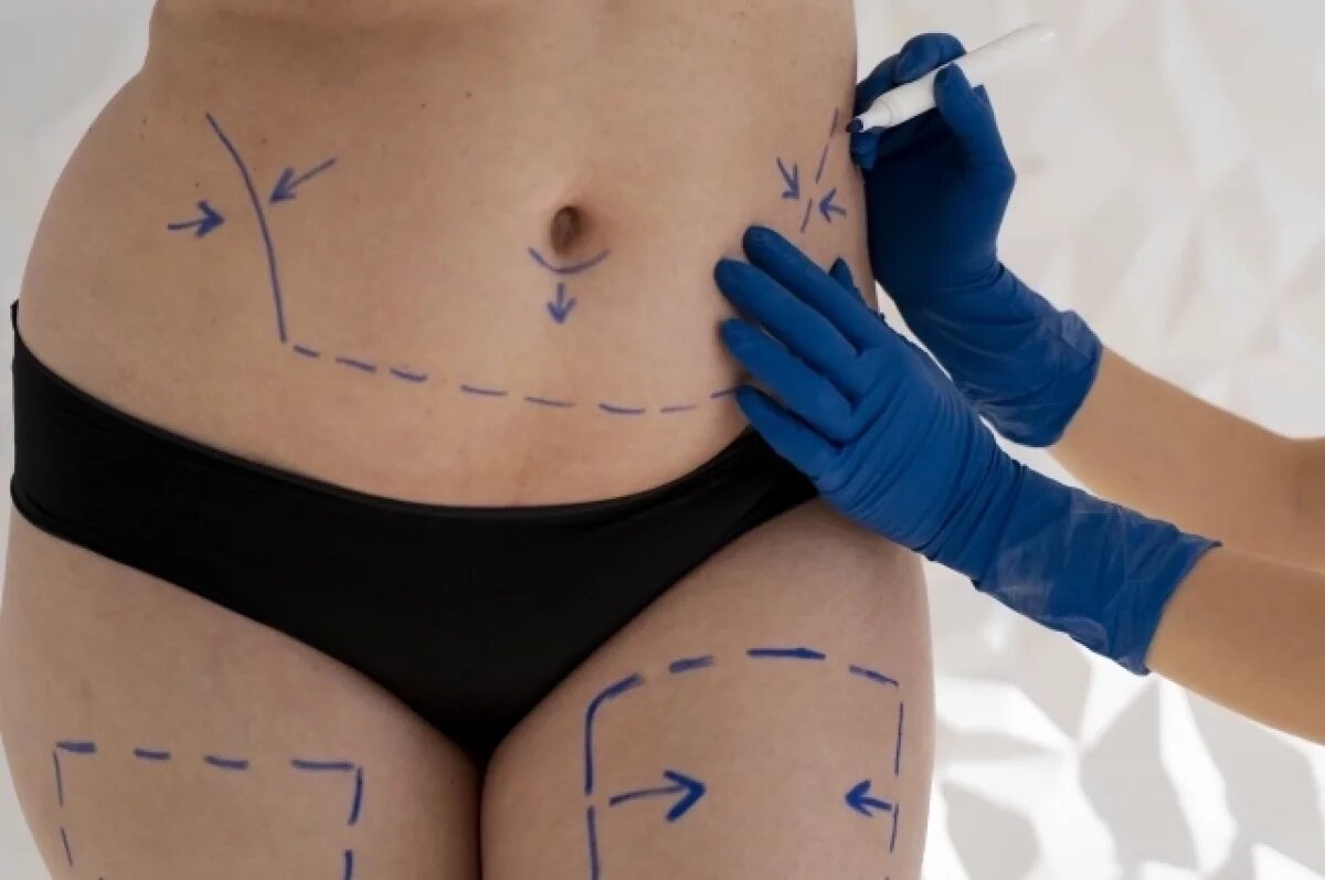    Смерть 44-летней петербурженки после липосакции стала уголовным делом