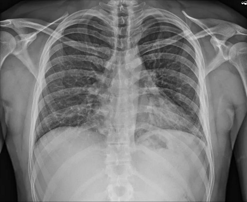    Сургутские врачи запатентовали новую методику лечения при переломе ребер