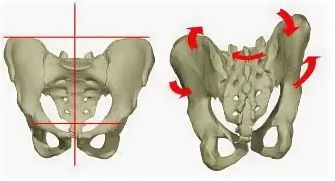 Самая распространённая причина смещение правой половинки таза(но даже это следствие других причин)