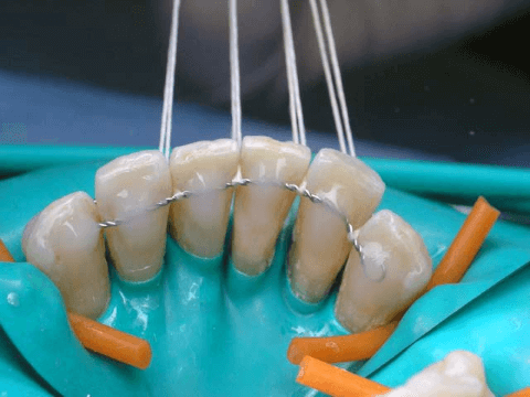 Шинирование травмированного зуба