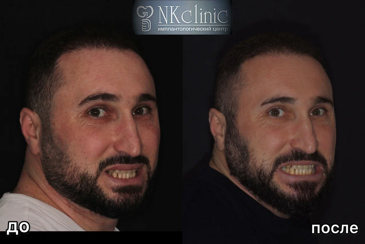 До и после лечения в NKclinic 