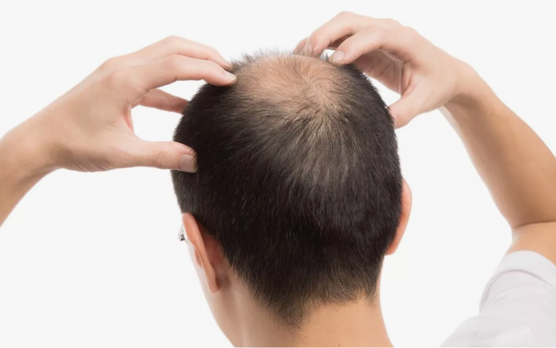 Лысина в наследство: можно ли остановить потерю волос? Топ - 7 мифов о о наследственном облысении.