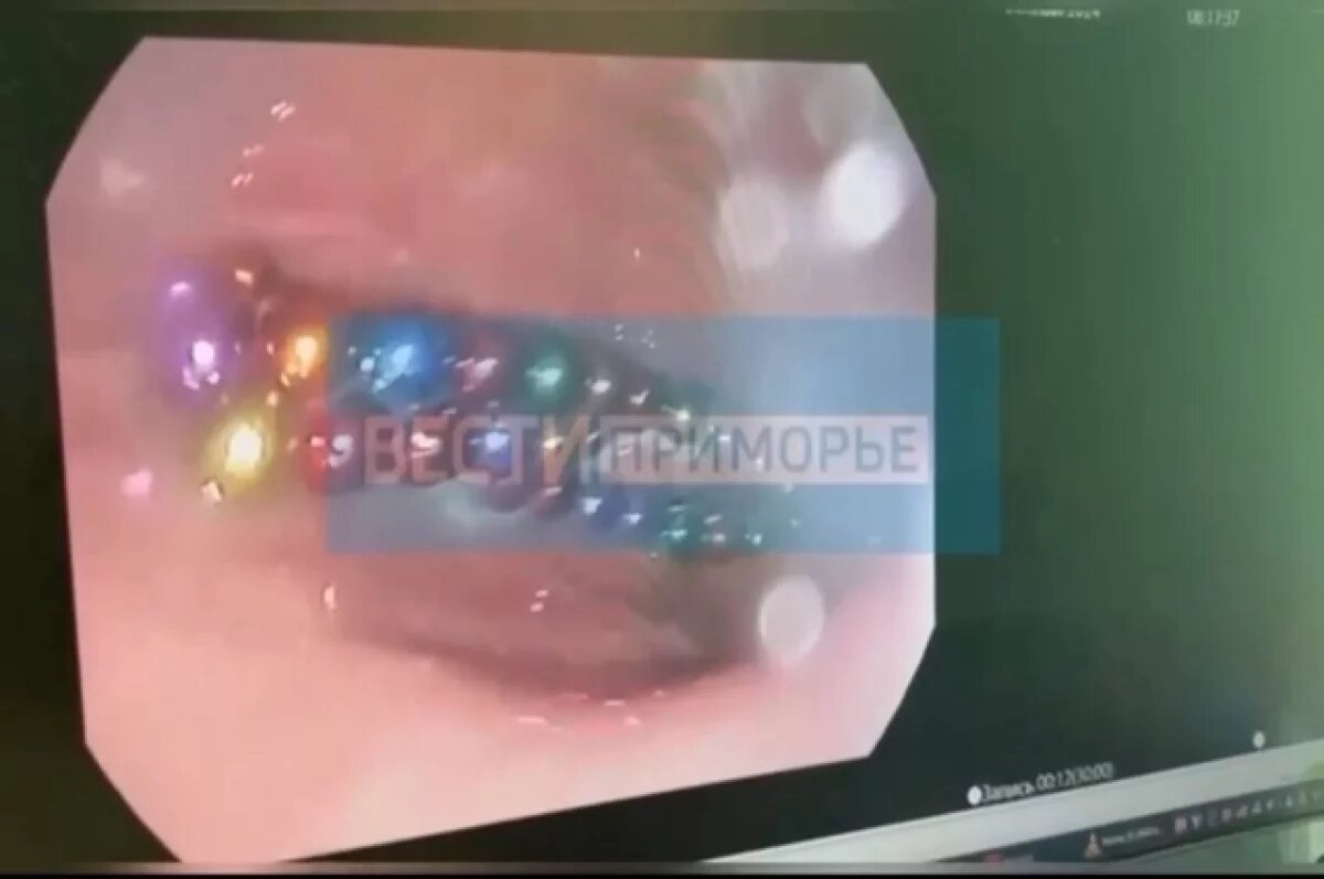    Сто магнитов достали врачи во Владивостоке из желудка 3-летнего ребенка