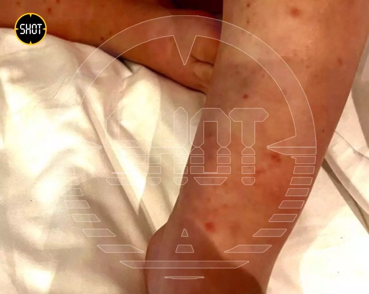 У одного из детей, заболевших в турецком отеле, на второй день болезни появились сильные высыпания. Фото: SHOT