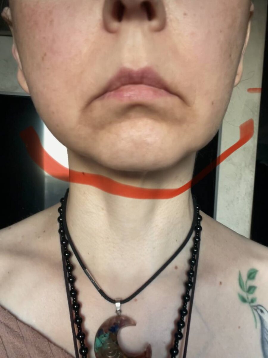 Брыли (бульдожьи щечки) - признак гравитационного (деформационного) типа старения.