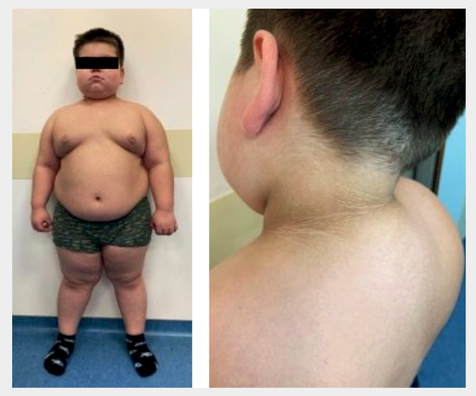 Внешний вид ребенка с избыточной выработкой кортизола. Статья: https://www.probl-endojournals.ru/jour/article/view/13102