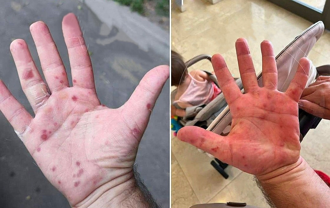 Одним и частых симптомов вируса Коксаки, является сыпь на ногах в области стоп и руках.