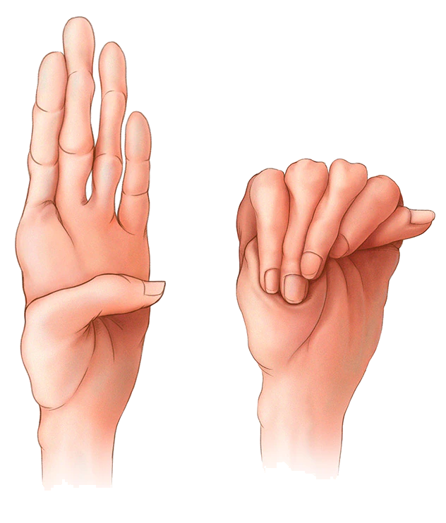 Рука пациента с синдромом Марфана